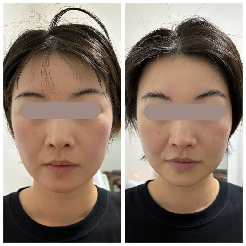 フェイス ビフォーアフター