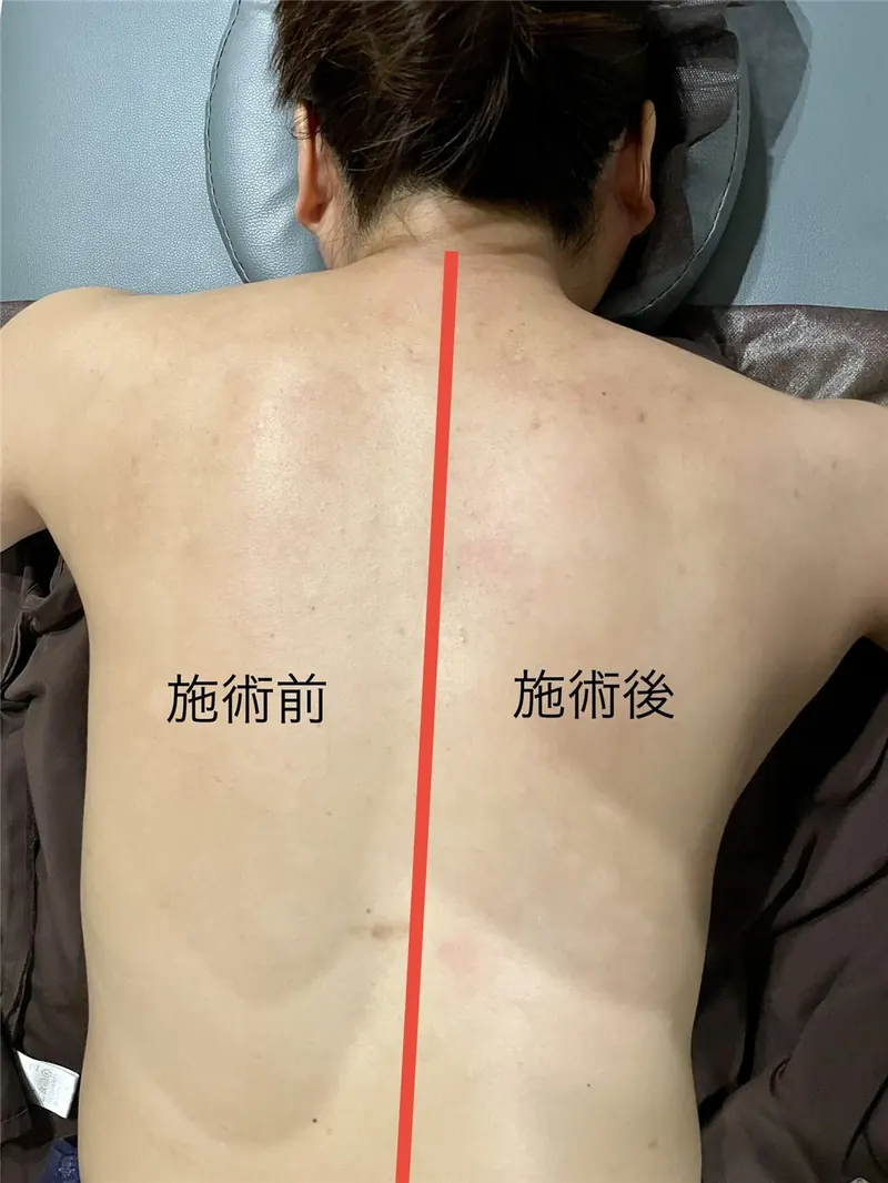 背中の施術前後比較